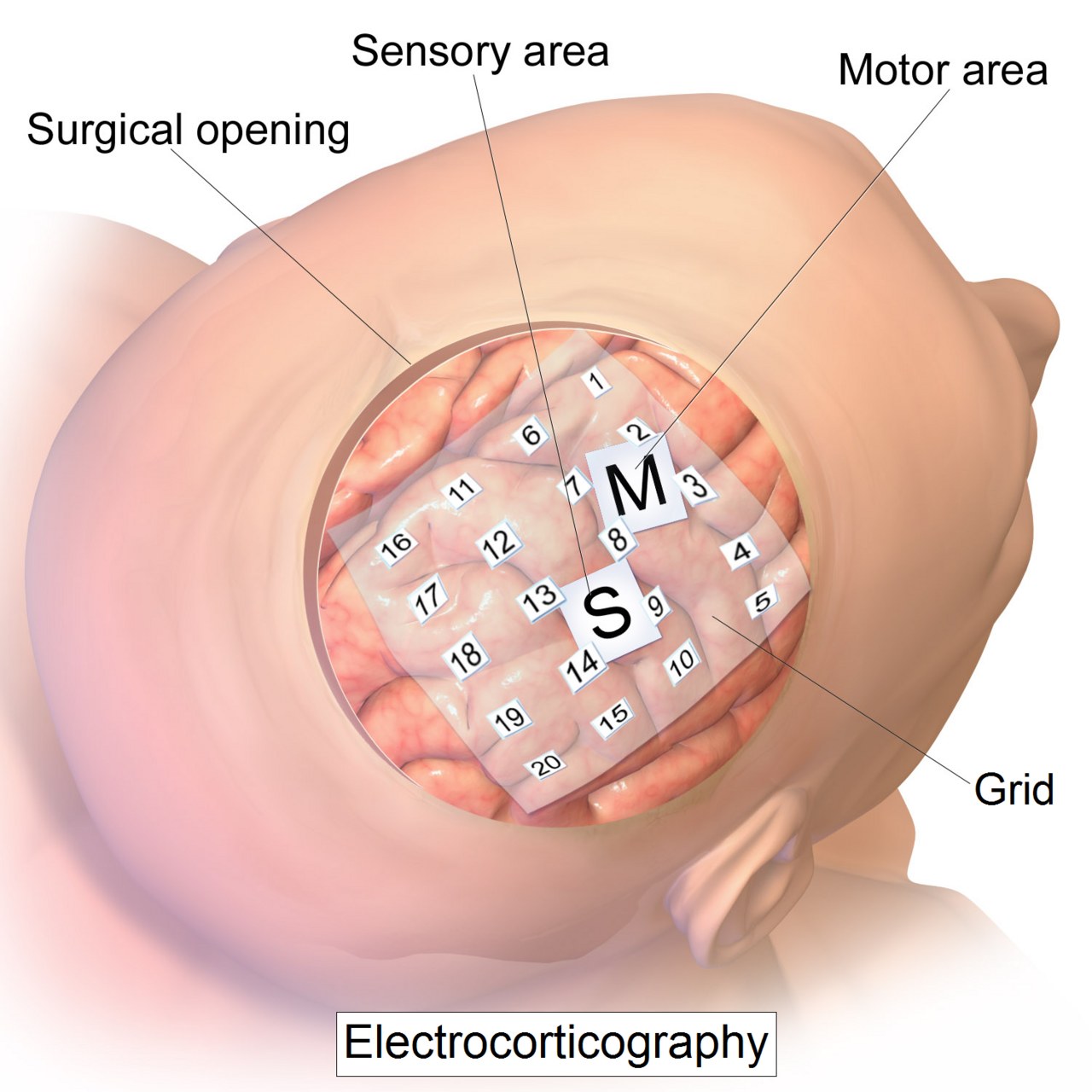 Medical illustration of an electrocorticography electrode grid, 2014. Background on recording brain signals; this depicts neither Neuralink’s device nor its surgical method.