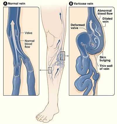 Varicose / venous disease illustration — contextual for CVI discussion, not a photo of Trump.
